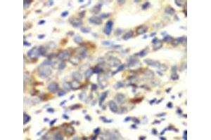 Immunohistochemistry of paraffin-embedded Human colon carcinoma using APLP1 Polyclonal Antibody at dilution of 1:100 (40x lens).