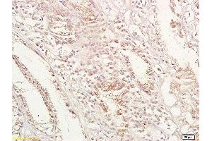 Formalin-fixed and paraffin embedded human gastric carcinoma labeled with Anti-GPA33 Polyclonal Antibody, Unconjugated (ABIN673644) at 1:200 followed by conjugation to the secondary antibody and DAB staining.