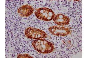 IHC image of ABIN7127518 diluted at 1:100 and staining in paraffin-embedded human colon cancer performed on a Leica BondTM system.