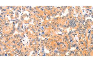 Immunohistochemistry of paraffin-embedded Human thyroid cancer tissue using THBS1 Polyclonal Antibody at dilution 1:60 (Thrombospondin 1 anticorps)