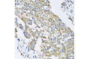 Immunohistochemistry of paraffin-embedded human lung cancer using SLC25A13 antibody. (slc25a13 anticorps  (AA 1-300))