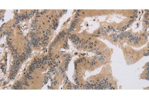 Immunohistochemistry of paraffin-embedded Human colon cancer tissue using ITIH1 Polyclonal Antibody at dilution of 1:30 (ITIH1 anticorps)