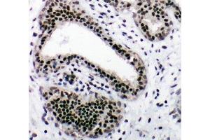 IHC-P: NRF1 antibody testing of human breast cancer tissue (NRF1 anticorps  (Middle Region))