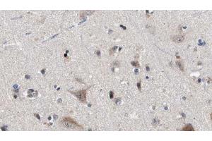 ABIN6272876 at 1/100 staining Human brain cancer tissue by IHC-P. (IFT81 anticorps)