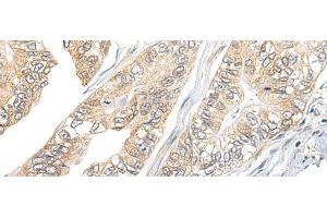 Immunohistochemistry of paraffin-embedded Human gastric cancer tissue using TBCB Polyclonal Antibody at dilution of 1:25(x200) (TBCB anticorps)