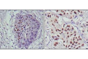 Immunohistochemical analysis of paraffin-embedded human esophageal cancer (left) and lung cancer (right), showing nuclear localization using p53 mouse mAb with DAB staining. (p53 anticorps)