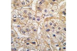 IHC analysis of FFPE human hepatocarcinoma tissue stained with the EGF Receptor antibody (EGFR anticorps  (AA 1048-1077))