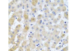 Immunohistochemistry of paraffin-embedded Human liver damage using EIF3M Polyclonal Antibody at dilution of 1:100 (40x lens). (Eukaryotic Translation Initiation Factor 3, Subunit M (EIF3M) anticorps)