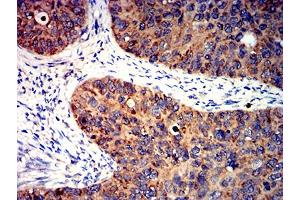 Immunohistochemical analysis of paraffin-embedded cervical cancer tissues using BCL2L2 mouse mAb with DAB staining.