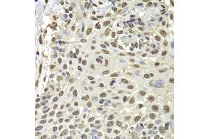 Immunohistochemistry of paraffin-embedded human well-differentiated squamous skin carcinoma using PUF60 antibody. (PUF60 anticorps)