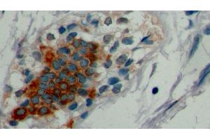 Detection of CK19 in Human Breast cancer Tissue using Monoclonal Antibody to Cytokeratin 19 (CK19)