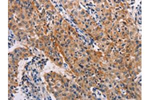 The image on the left is immunohistochemistry of paraffin-embedded Human lung cancer tissue using ABIN7128260(ADH1A Antibody) at dilution 1/20, on the right is treated with fusion protein.