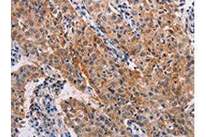 The image on the left is immunohistochemistry of paraffin-embedded Human lung cancer tissue using ABIN7128260(ADH1A Antibody) at dilution 1/20, on the right is treated with fusion protein. (ADH1A anticorps)