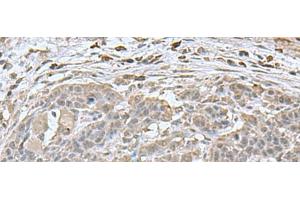 Immunohistochemistry of paraffin-embedded Human esophagus cancer tissue using NEUROG3 Polyclonal Antibody at dilution of 1:70(x200)