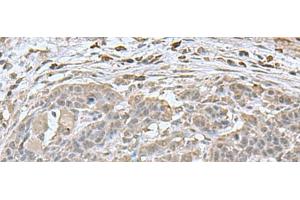 Immunohistochemistry of paraffin-embedded Human esophagus cancer tissue using NEUROG3 Polyclonal Antibody at dilution of 1:70(x200) (Neurogenin 3 anticorps)