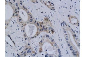 Formalin-fixed and paraffin embedded human colon labeled with Anti Styk1 Polyclonal Antibody, Unconjugated  followed by conjugation to the secondary antibody and DAB staining (STYK1 anticorps  (AA 51-150))