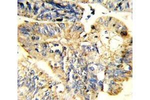 IHC analysis of FFPE human colon carcinoma stained with LIF antibody
