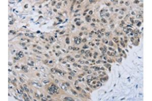 The image on the left is immunohistochemistry of paraffin-embedded Human esophagus cancer tissue using ABIN7192404(SLC16A4 Antibody) at dilution 1/80, on the right is treated with synthetic peptide.
