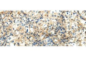 Immunohistochemistry of paraffin-embedded Human prostate cancer using WNT2 Polyclonal Antibody at dilution of 1/40