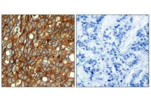 Immunohistochemical analysis of paraffin-embedded human breast carcinoma tissue using HER2 (Phospho-Tyr1248) Antibody (left) or the same antibody preincubated with blocking peptide (right). (ErbB2/Her2 anticorps  (pTyr1248))