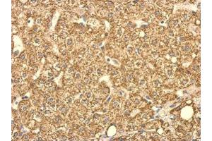 IHC-P Image SUCLG2 antibody detects SUCLG2 protein at cytosol on human hepatoma by immunohistochemical analysis. (SUCLG2 anticorps)