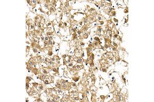 Immunohistochemistry of paraffin-embedded human liver cancer using Smad9 Rabbit pAb (ABIN6132668, ABIN6148096, ABIN6148097 and ABIN6223425) at dilution of 1:100 (40x lens). (SMAD9 anticorps  (AA 1-300))