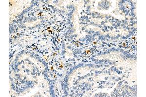 ABIN6264995 and ABIN6273073 at 1/100 staining Human lung cancer by IHC-P.