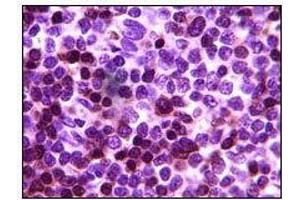 Immunohistochemical analysis of paraffin-embedded human lymph tumor, showing cytoplasmic localization using ZAP70 mouse mAb with DAB staining