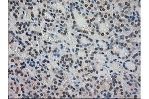 Immunohistochemical staining of paraffin-embedded Carcinoma of thyroid tissue using anti-STK39mouse monoclonal antibody. (STK39 anticorps)