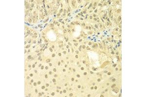 Immunohistochemistry of paraffin-embedded human oophoroma using TBL1XR1 antibody at dilution of 1:100 (x400 lens).