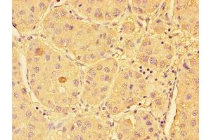 Immunohistochemistry of paraffin-embedded human liver cancer using ABIN7170581 at dilution of 1:100