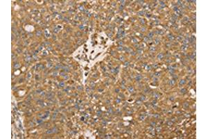 The image on the left is immunohistochemistry of paraffin-embedded Human breast cancer tissue using ABIN7130945(RRBP1 Antibody) at dilution 1/25, on the right is treated with fusion protein. (RRBP1 anticorps)