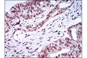 Immunohistochemical analysis of paraffin-embedded rectum cancer tissues using ZEB1 mouse mAb with DAB staining. (ZEB1 anticorps  (AA 967-1108))