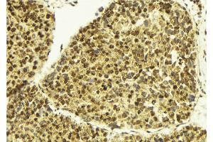 ABIN6273407 at 1/100 staining Human breast cancer tissue by IHC-P. (TSEN2 anticorps  (Internal Region))
