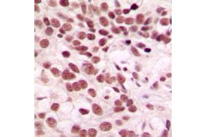 Immunohistochemical analysis of CTDSP1 staining in human breast cancer formalin fixed paraffin embedded tissue section.