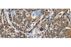 Immunohistochemistry of paraffin-embedded Human thyroid cancer tissue using CIR1 Polyclonal Antibody at dilution of 1:40(x200) (CIR1 anticorps)