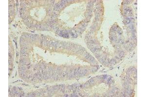 Immunohistochemistry of paraffin-embedded human endometrial cancer using ABIN7146467 at dilution of 1:100 (Calmegin anticorps  (AA 200-400))