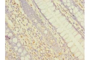 Immunohistochemistry of paraffin-embedded human colon cancer using ABIN7144926 at dilution of 1:100 (ABCF3 anticorps  (AA 201-500))