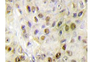 Immunohistochemical analysis of paraffin-embedded human breast cancer tissue using RORA polyclonal antibody . (RORA anticorps)