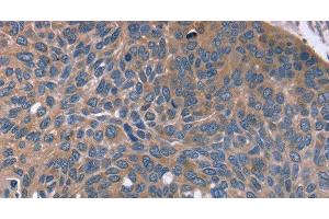 Immunohistochemistry of paraffin-embedded Human esophagus cancer tissue using RGS4 Polyclonal Antibody at dilution 1:30 (RGS4 anticorps)