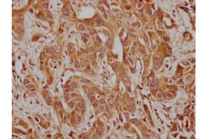 IHC image of ABIN7175608 diluted at 1:100 and staining in paraffin-embedded human liver cancer performed on a Leica BondTM system.