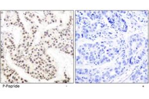 Immunohistochemical analysis of paraffin-embedded human breast carcinoma tissue using ELK1 (phospho T417) polyclonal antibody. (ELK1 anticorps  (pThr417))