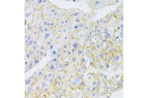 Immunohistochemistry of paraffin-embedded human liver cancer using ABCC1 Antibody.