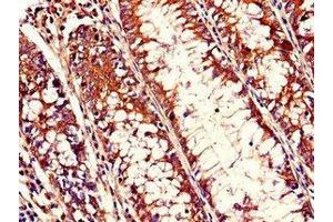 Immunohistochemistry of paraffin-embedded human colon cancer using ABIN7168038 at dilution of 1:100 (RHOH anticorps  (AA 1-188))