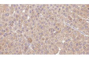ABIN6273654 at 1/100 staining Human Melanoma tissue by IHC-P. (IL36A/IL1F6 anticorps  (Internal Region))