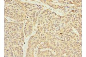 Immunohistochemistry of paraffin-embedded human ovarian cancer using ABIN7159905 at dilution of 1:100 (TIMM23 anticorps  (AA 1-209))