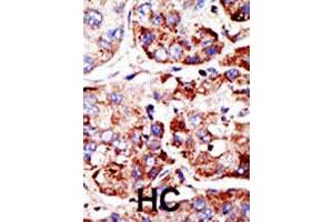 Formalin-fixed and paraffin-embedded human hepatocellular carcinoma tissue reacted with PIAS2 polyclonal antibody , which was peroxidase-conjugated to the secondary antibody, followed by DAB staining. (PIAS2 anticorps  (C-Term))