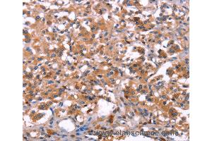 Immunohistochemistry of Human thyroid cancer using LILRB1 Polyclonal Antibody at dilution of 1:30 (LILRB1 anticorps)