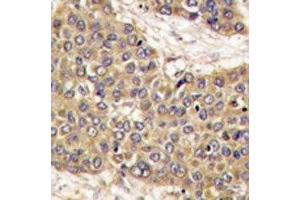 IHC analysis of FFPE human hepatocarcinoma tissue stained with Caspase-6 antibody (Caspase 6 anticorps  (AA 235-263))