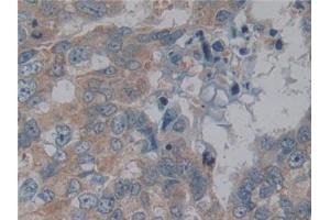 Detection of NFkB in Human Breast cancer Tissue using Polyclonal Antibody to Nuclear Factor Kappa B (NFkB)